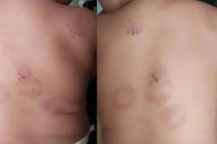 Direção de creche se pronuncia sobre caso de mordida em criança.