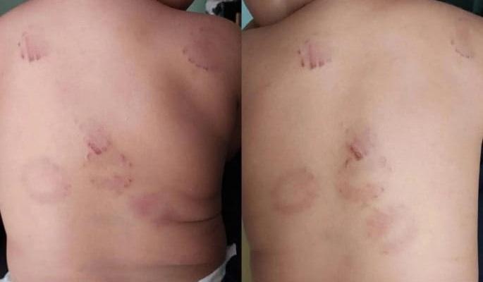 Direção de creche se pronuncia sobre caso de mordida em criança.